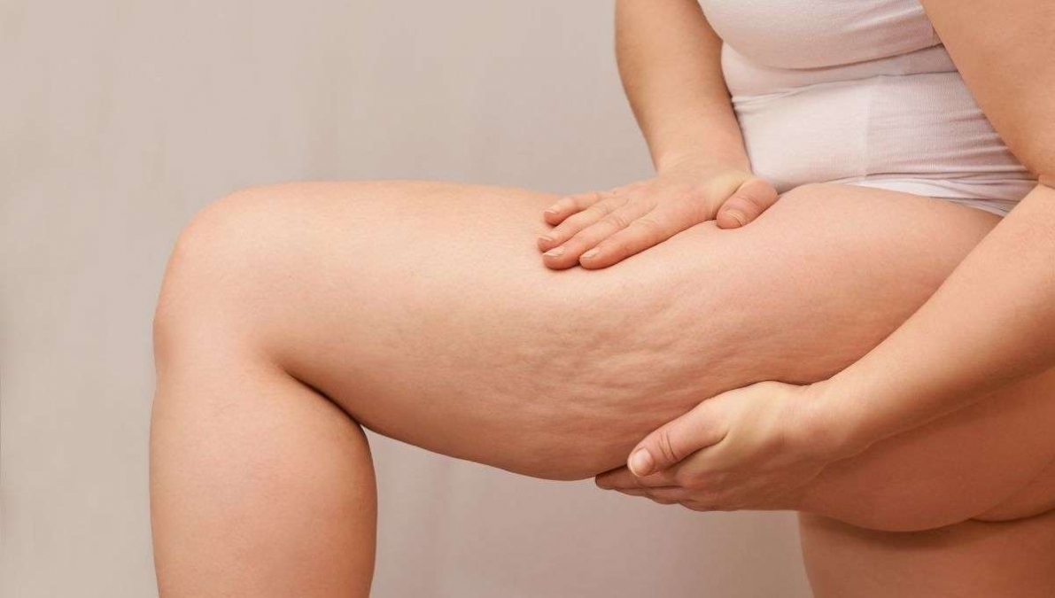 La celulitis puede eliminarse con tratamientos - Canva