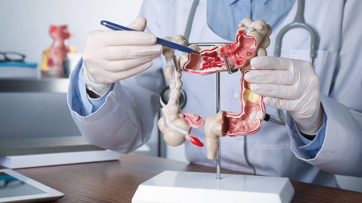 Detección de cáncer colorrectal - Canva Detección de cáncer colorrectal - Canva