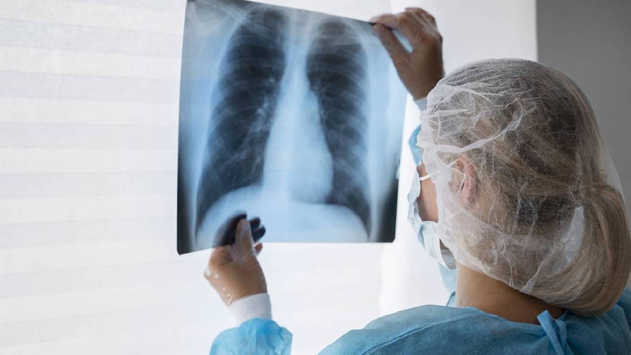 Un estudio equipara la radioterapia a la cirugía para cáncer de pulmón de células no pequeñas