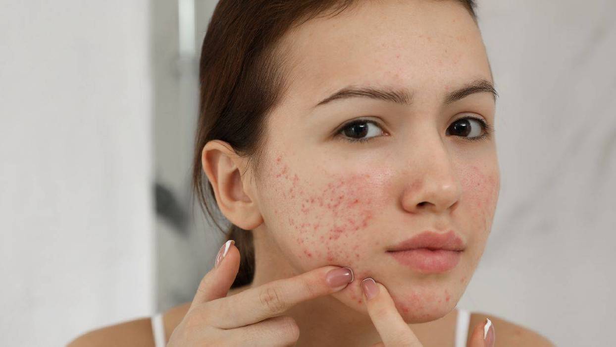 Tu piel merece ciencia: descubre el poder del ácido salicílico encapsulado