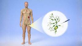 Un nuevo tejido bioingenierizado podría aliviar el linfedema secundario tras extirpaciones de ganglios