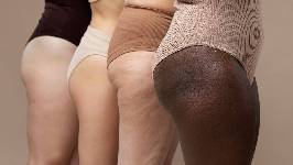 La postura corporal, un factor determinante en el desarrollo de la celulitis