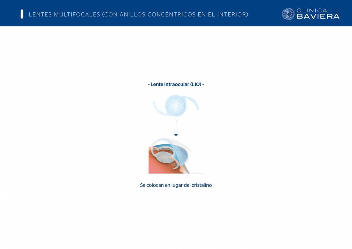 Operarse de la vista en la madurez: miedos más comunes y realidades ...