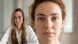 ¿Parches para granos en toda la cara? Los dermatólogos advierten sobre estos adhesivos virales