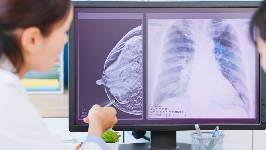 Una sonda portátil de bajo coste revolucionará la cirugía de cáncer de mama al distinguir el tumor del tejido sano al tacto