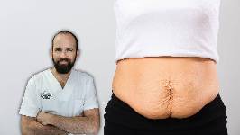 Diástasis abdominal: "La fisioterapia va a ayudar a mejorar la función del abdomen"
