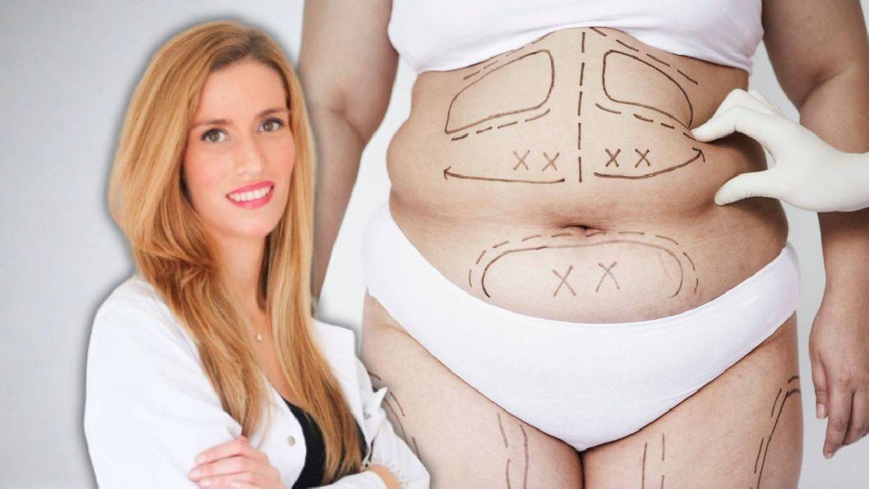 ¿Es seguro moldear varias partes del cuerpo en una sola liposucción? Una doctora aclara la duda