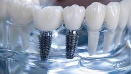 La periimplantitis replantea el cuidado de los implantes: “Debe seguir un protocolo no abrasivo” 